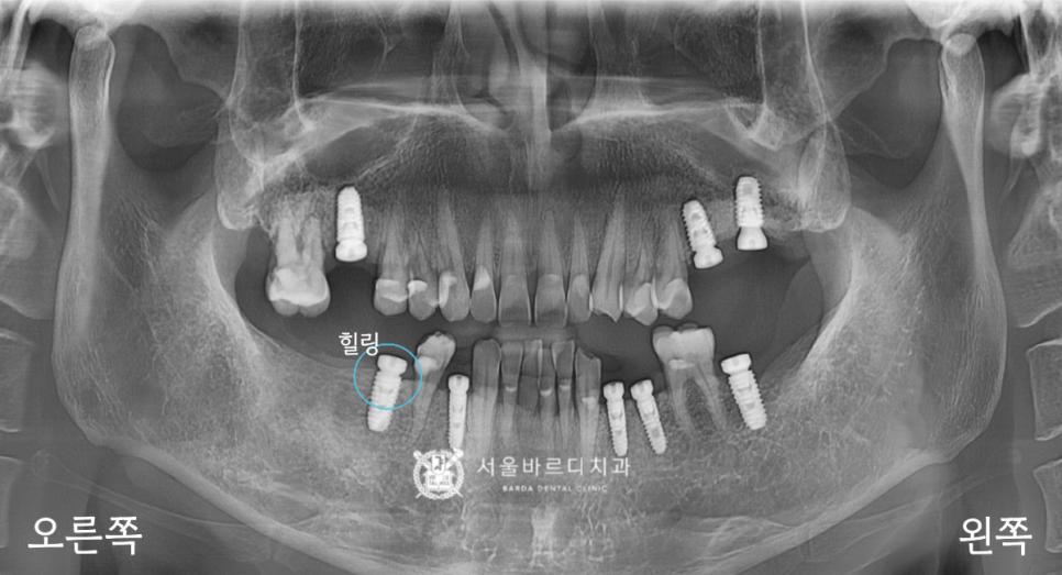 고덕동치과 서울바르디치과 무절개 네비게이션 임플란트 치료증례 #1 관련 이미지 13