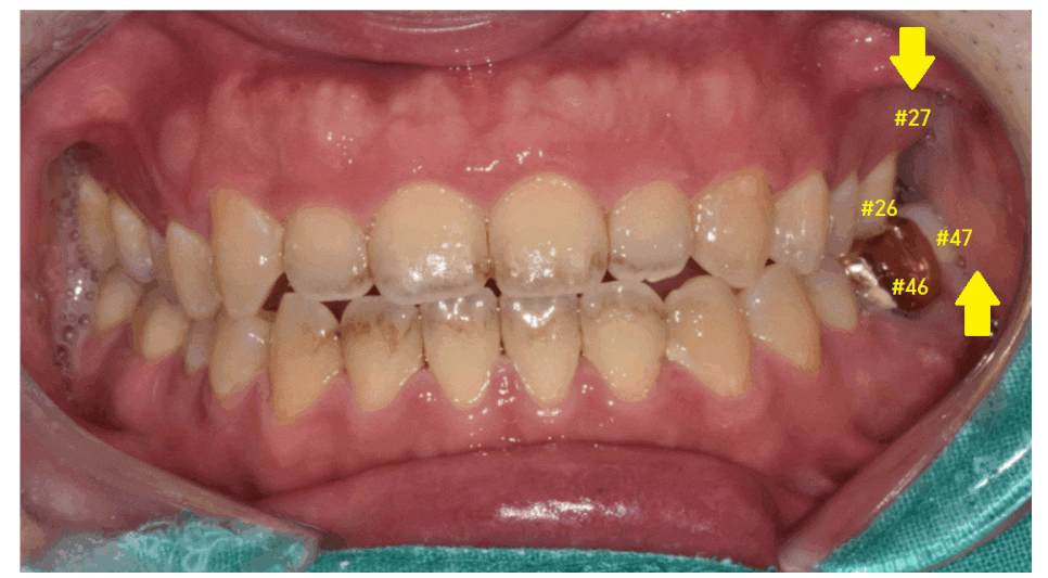 암사동 치과 임플란트 꼭 안 해도 되는 경우 궁금증 해결해 드려요 관련 이미지 1