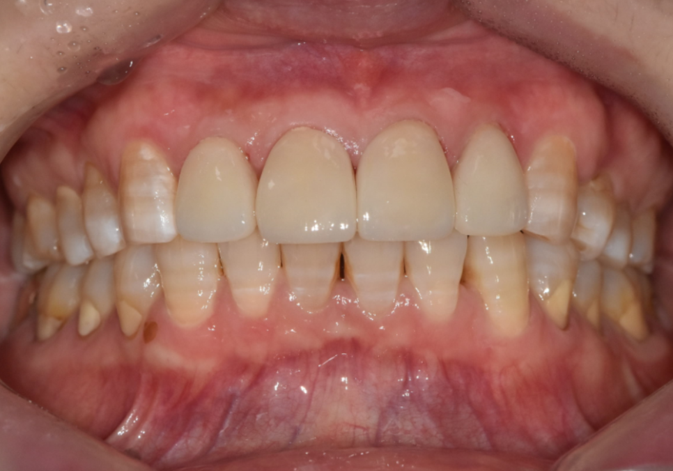 앞니 변색, 치아미백효과 없는 이유 솔직하게 말씀드립니다. 관련 이미지 8