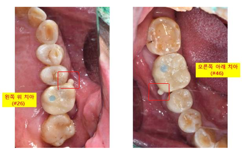 서울바르디치과 상하악 대구치 네비게이션 임플란트 치료증례 #4 관련 이미지 20
