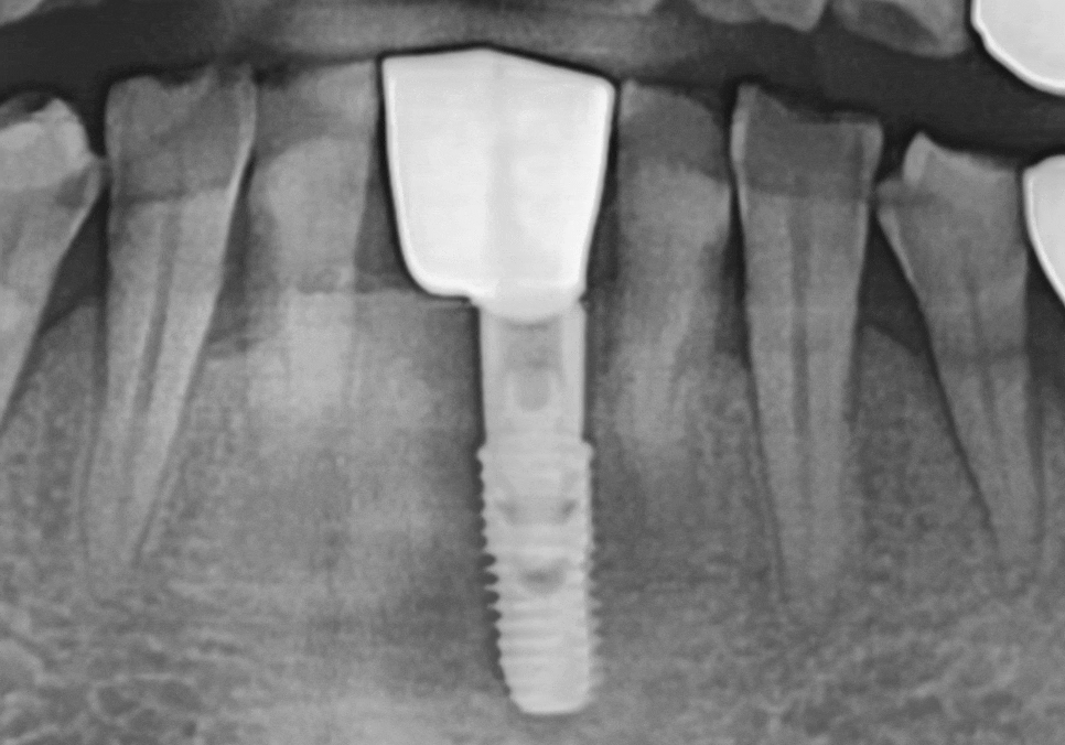 강동구 임플란트 가격 줄이는 방법 2개 발치했는데, 1개만 심어도 된다구요? 관련 이미지 12