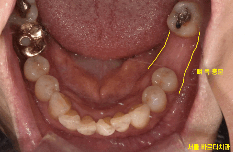 풍산동 치과 아래 어금니 임플란트 뼈 이식 없이 해결했습니다. 관련 이미지 1