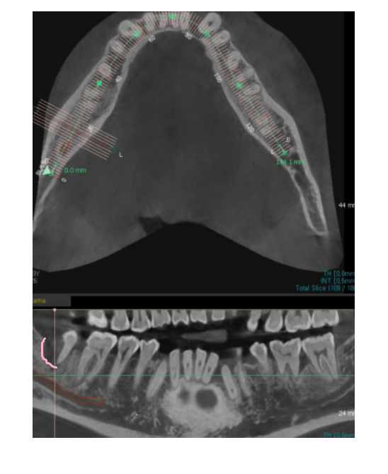 덕풍동 치과 잇몸 욱신 욱신 원인 찾아 임플란트 수술하였습니다. 관련 이미지 6