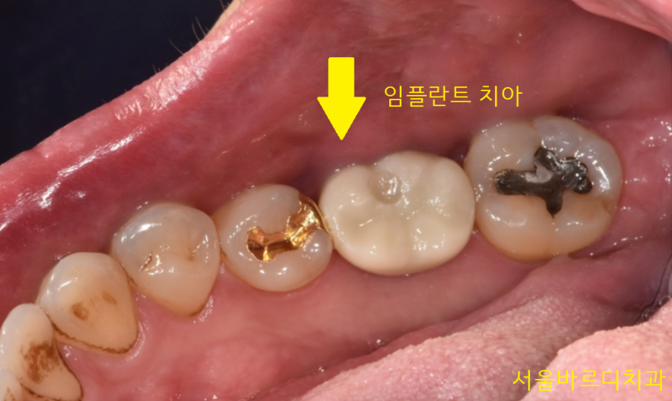 감일동 치과 첫번째 임플란트 시작이 중요합니다. 관련 이미지 11