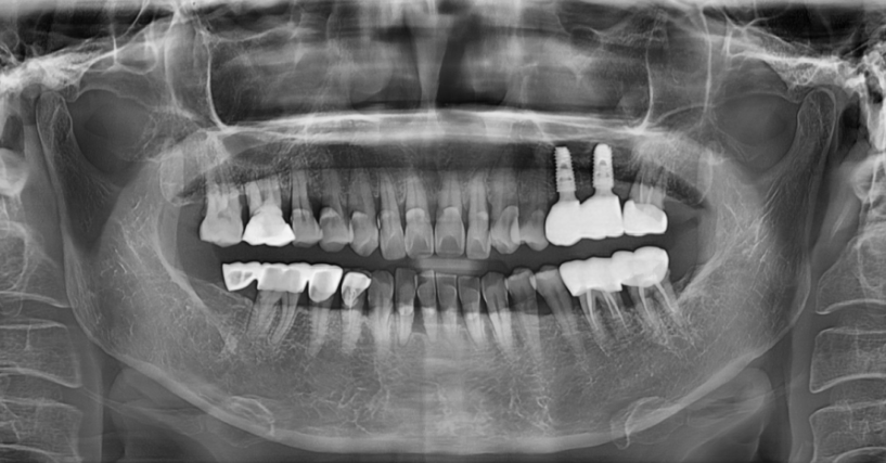 서울 네비게이션 임플란트 치과 불안할 때 좋은 선택지가 될 수 있습니다. 관련 이미지 8