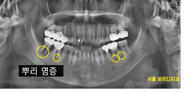강일동 치과 잇몸뼈 녹음 발치 후 임플란트로 해결했습니다. 관련 이미지 2