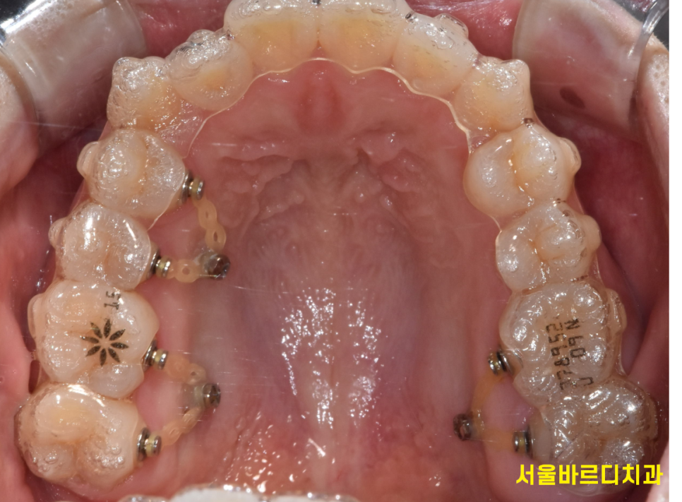 교정중 미니스크류 필수일까? 투명교정도 때로는 필요하다 관련 이미지 7