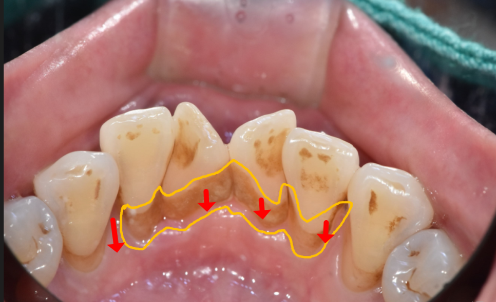 잇몸 내려감으로 길어진 치아, 방치하면 안 되는 원인, 증상, 이유 관련 이미지 1