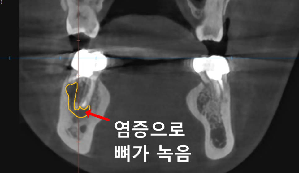 고덕동 20대 임플란트, 시기 놓치면 비용 2배 이상 듭니다. 관련 이미지 6