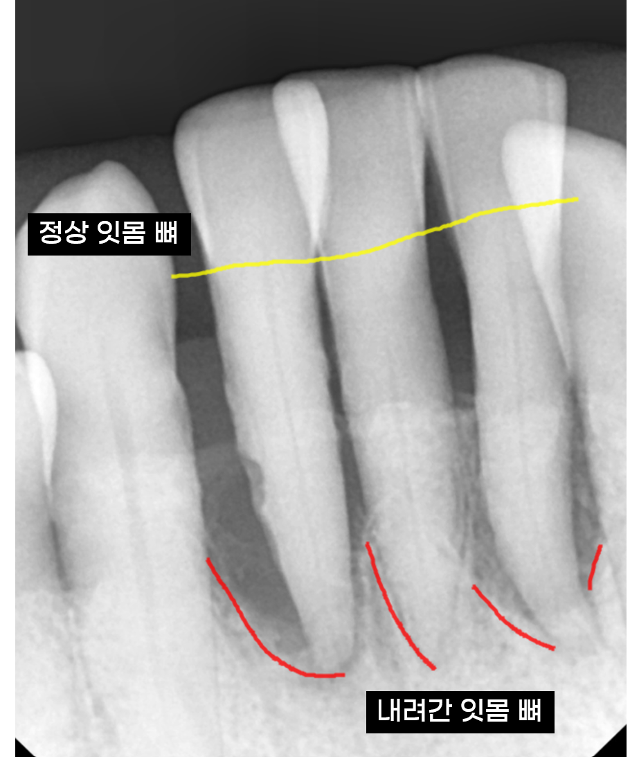 아래 앞니 임플란트 잇몸 염증 고름으로 인한 흔들림이 심해질때 관련 이미지 3