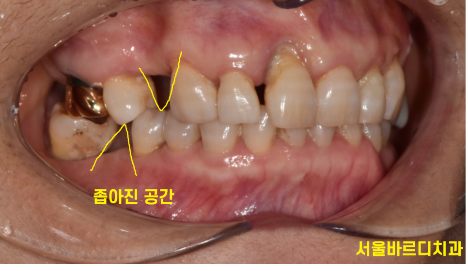 고덕동 치과 발치 후 방치하면 치아 쓰러짐 발생해요 관련 이미지 4