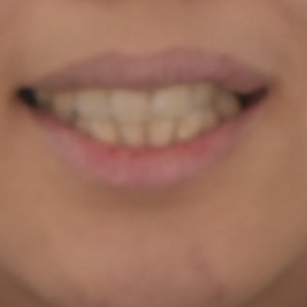 상일동 치아 교정 시작 전에 꼭 읽어보세요. 관련 이미지 4