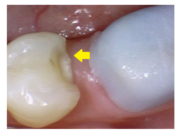 어금니 치아 파절 부러짐 발치까지 이어질 수 있습니다. 관련 이미지 2
