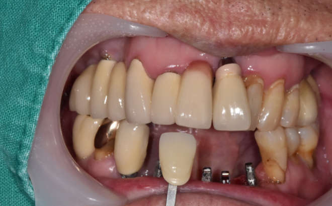강동구 치과 앞니 흔들림 임플란트 케이스 관련 이미지 7