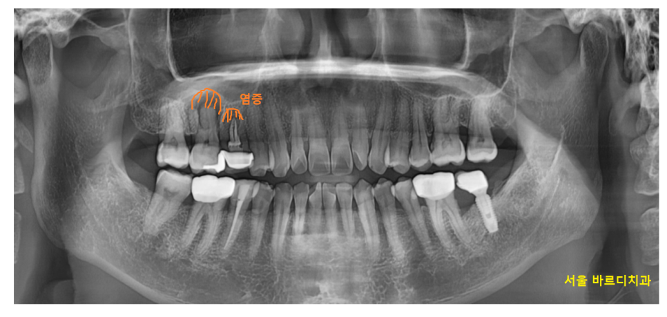 고덕역 임플란트 잇몸 뾰루지 뼈이식 두번 하여 해결했습니다. 관련 이미지 2