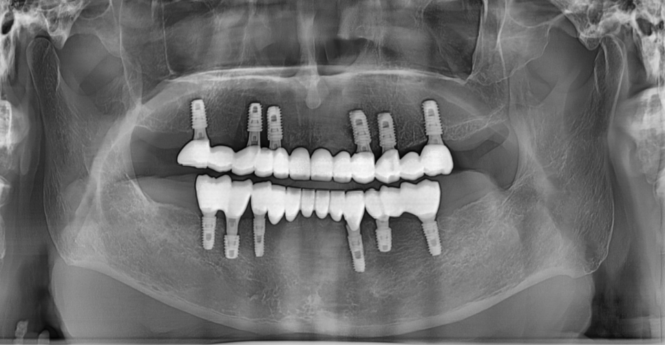 Is It Difficult to Shorten the Implant Procedure Period? Why It Differs from Person to Person image 1