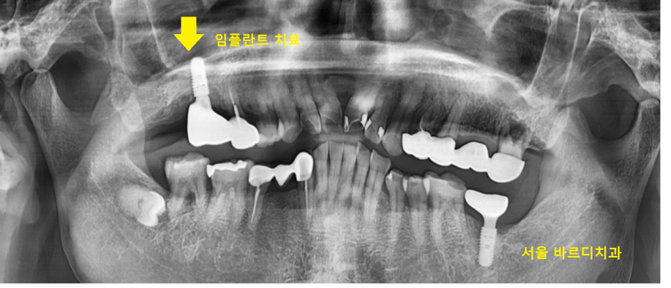명일역 근처 치과 치아 뿌리 염증이 생겨서 고생하신 사연 관련 이미지 8