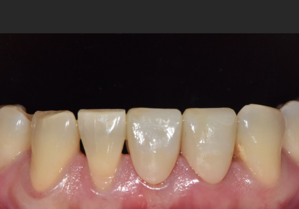 Spaces Between Front Teeth Due to Congenital Missing Teeth: Is Orthodontic Treatment the Only Answer? image 8