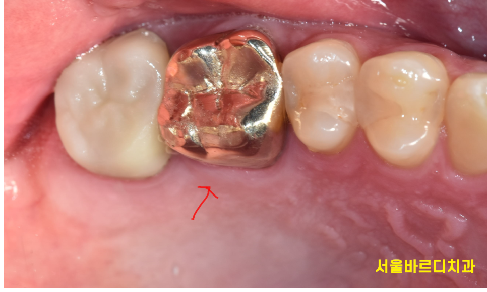 발치 대신 신경치료 뽑기 전 치료는 한번 해봐야하지않을까요? 관련 이미지 4