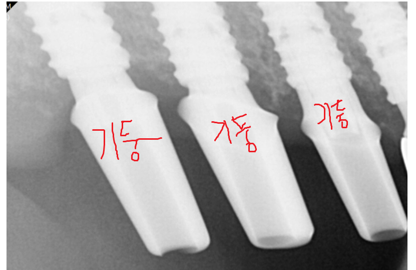 예전에 씌운 이 상악동 거상술 뼈이식 동반하여 임플란트 완료 관련 이미지 7