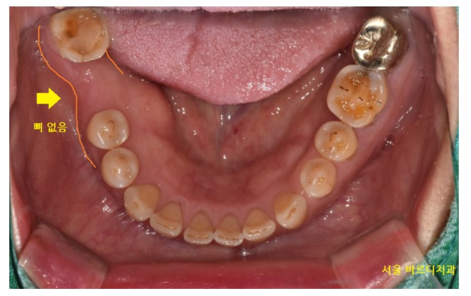 강동구 치과 약먹는게 많은데 임플란트 수술 할 수 있나요?? 관련 이미지 4