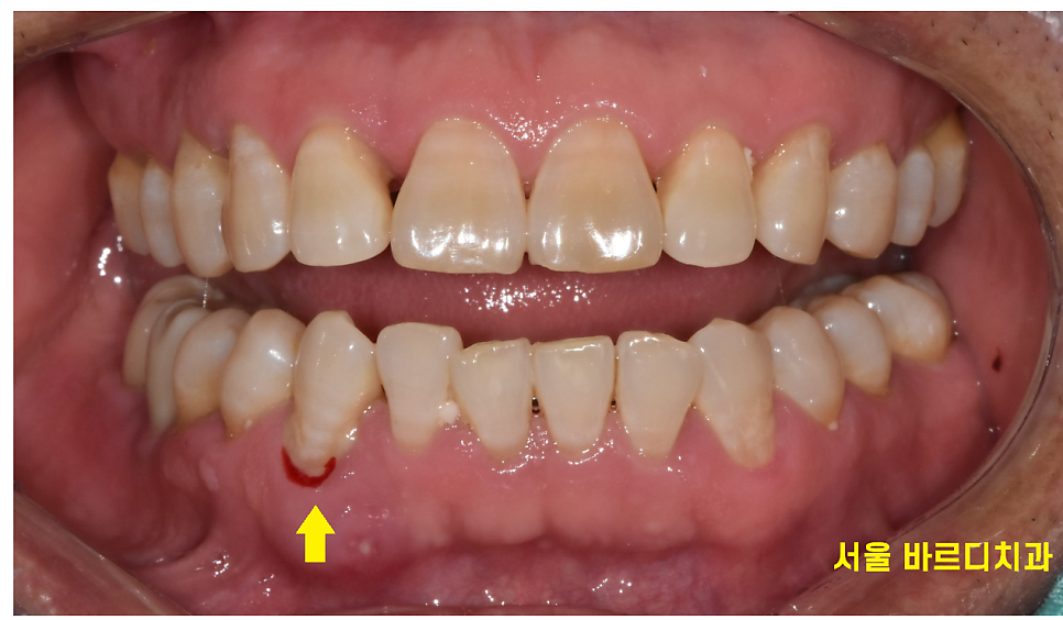 잇몸 고름 냄새 약으로 없앨 수는 없나요? 무시 무시한 치주염 관련 이미지 3