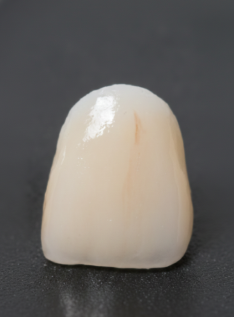 명일동 치과, 잇몸이 검게 변했다면? 앞니 변색 원인은 바로 관련 이미지 14