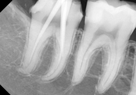 고덕동 사랑니 매복 발치, 안 아픈데 꼭 빼야 하나요? 관련 이미지 15