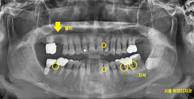강일동 치과추천 어금니 시림 방치하지마세요 발치하고 임플란트 할 수 있습니다. 관련 이미지 5