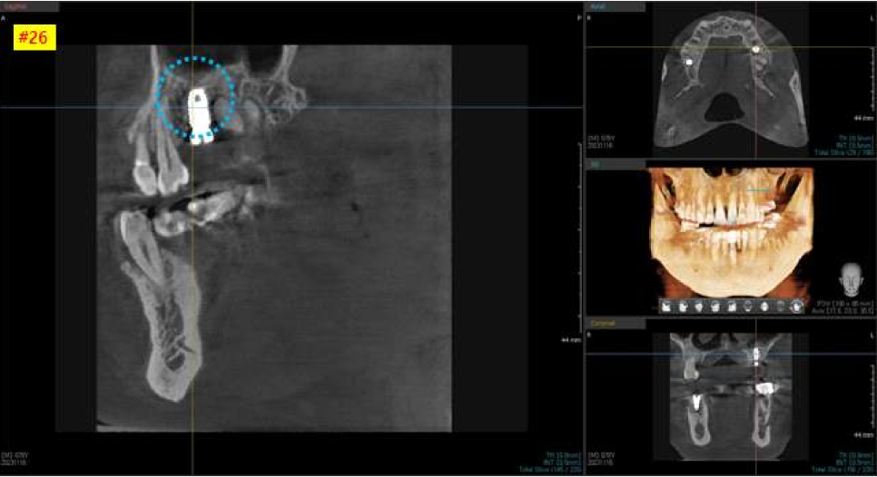 서울바르디치과 상하악 대구치 네비게이션 임플란트 치료증례 #4 관련 이미지 13