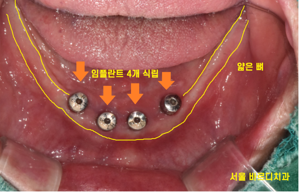 상일동 근처 치과 얇은뼈 틀니 안될 때 해결 방법은?? 관련 이미지 7