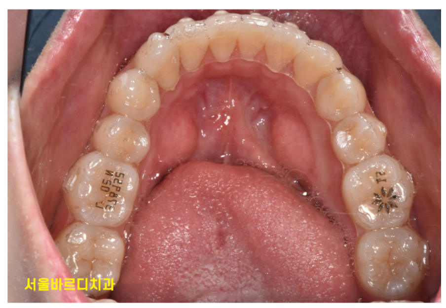 상일동 근처 교정 다시 삐뚤어진 치아 치료하기 관련 이미지 3