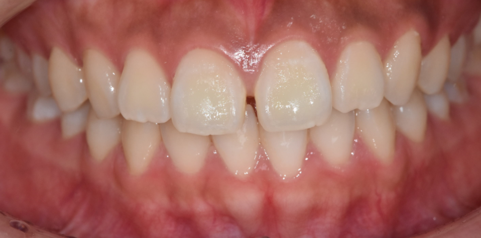 3 Ways to Fix Gaps Between the Front Teeth with Orthodontic Treatment image 2