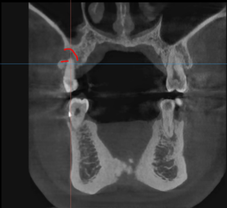 상일동역 치과 잇몸 뼈 녹음 임플란트 케이스 관련 이미지 4