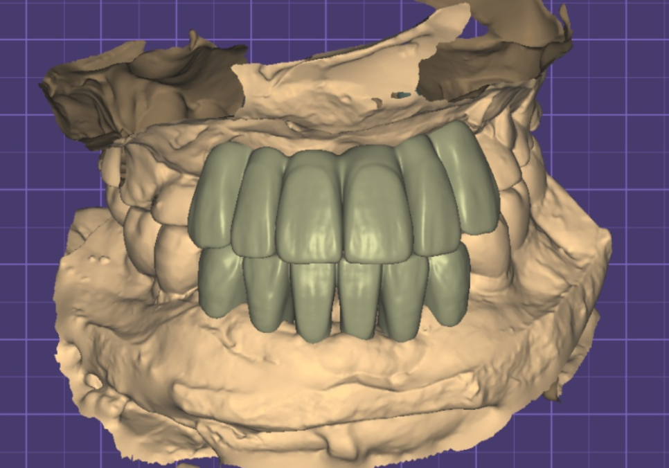 앞니 임플란트, 원내 기공소의 중요성을 아시나요? 관련 이미지 1