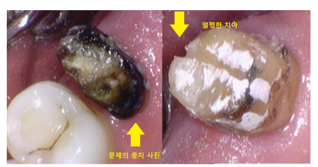 고덕역 근처 치과 브릿지와 임플란트 고민 중이신 분들 클릭하세요 관련 이미지 7