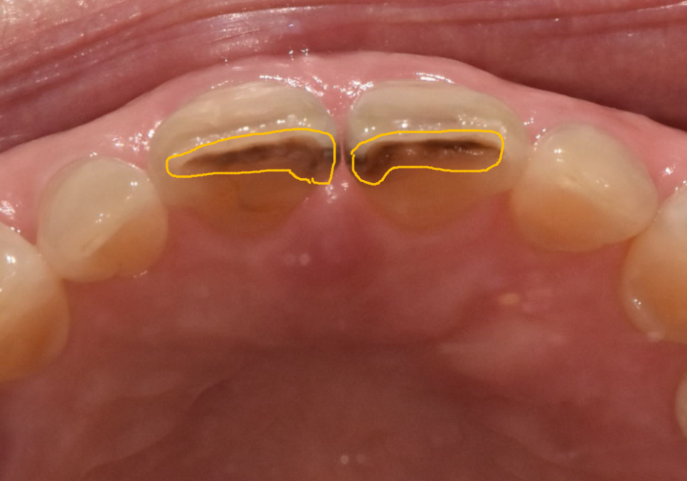 마모된 윗 앞니가 까맣게 변했다면? 방치하면 안 되는 이유 관련 이미지 4