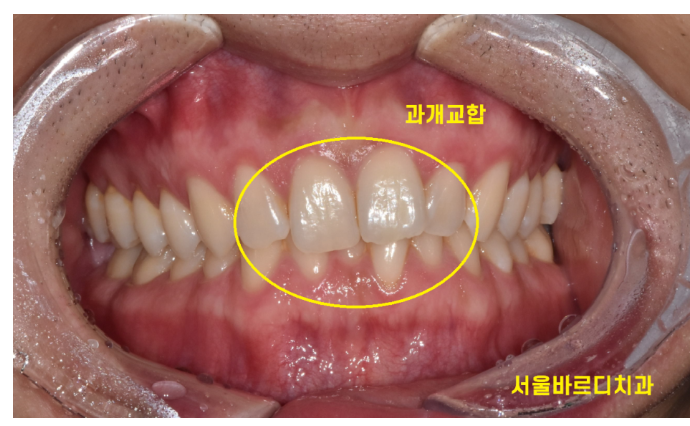 고덕동 교정치과 부정교합은 무엇인가요? 어떨때 치료가 필요한가요? 관련 이미지 5