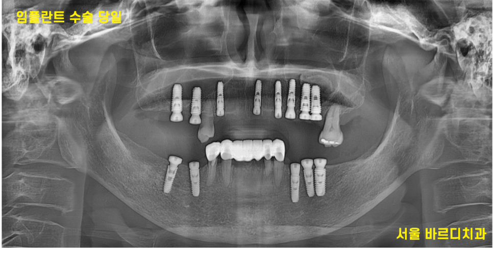 전체적인 치아 치료 13개의 임플란트를 식립한 환자분 관련 이미지 11