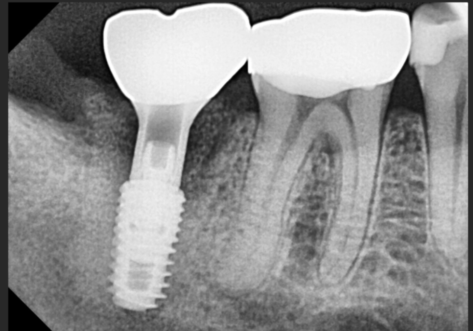 강동구 임플란트 기간, 사람마다 왜 다를까? 즉시식립과 지연식립의 결정적 차이 관련 이미지 10