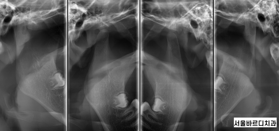상일동역 치아교정 부작용 꼭 알아보고 대처하세요!!! 관련 이미지 4
