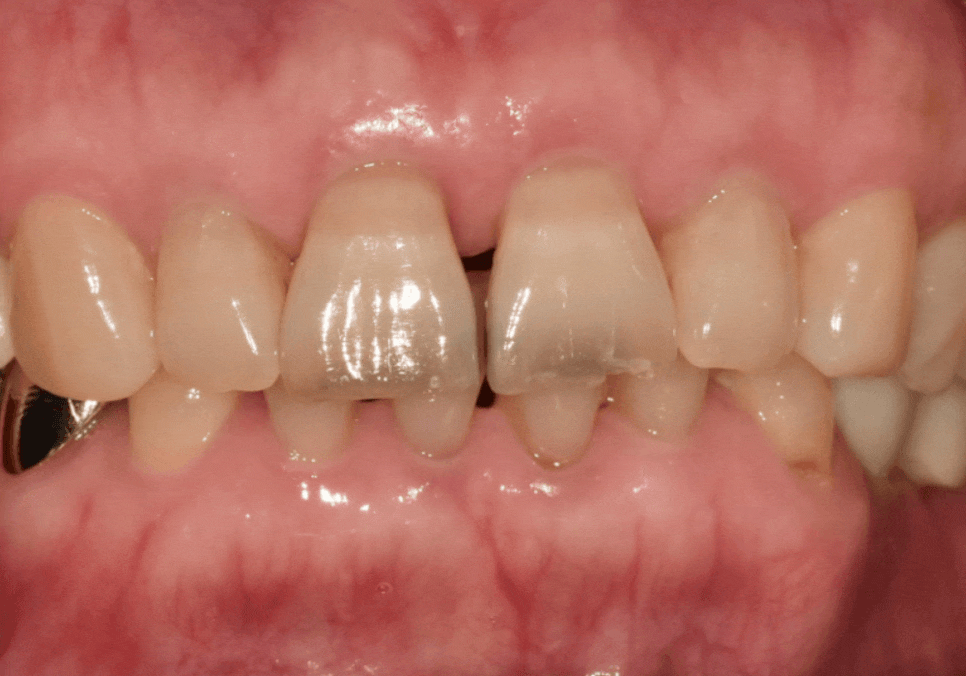 마모된 윗 앞니가 까맣게 변했다면? 방치하면 안 되는 이유 관련 이미지 2