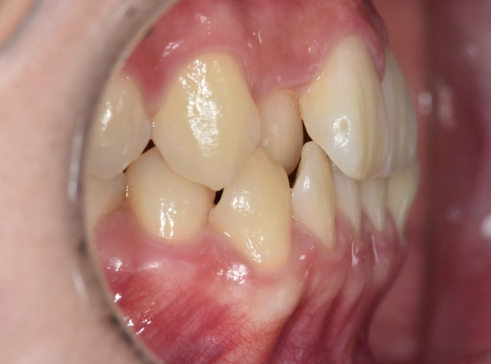 앞니 덧니 때문에 웃기 불편하다면? 상일동에서 치아교정 솔루션 관련 이미지 4