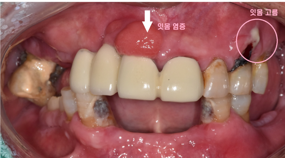 천호동 치과 자연 발치 후 방치된 치아 임플란트 케이스 관련 이미지 2
