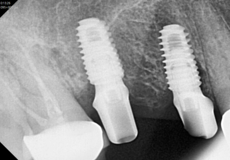 강동구 오래된 보철, 교체 시기는? 아프지 않은데 꼭 바꿔야 하나요? 관련 이미지 9