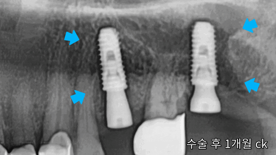 서울바르디치과 뿌리 끝 염증 심한 치아를 네비게이션 임플란트 #6 관련 이미지 13