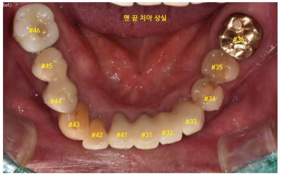 암사동 치과 임플란트 꼭 안 해도 되는 경우 궁금증 해결해 드려요 관련 이미지 12