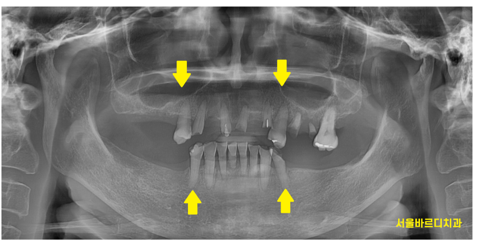강동구 임플란트 어금니 상실 방치하다 치매까지 옵니다. 관련 이미지 3