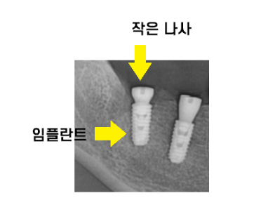 길동 치과 임플란트 2차 수술이요? 예전에 했잖아요 관련 이미지 5