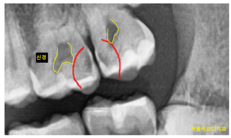 충치치료 후 이시림 자연스러운 반응일까 후유증일까? 관련 이미지 2
